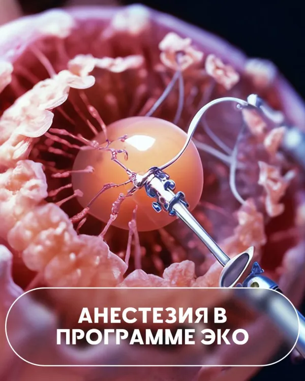 Анестезия в программе ЭКО